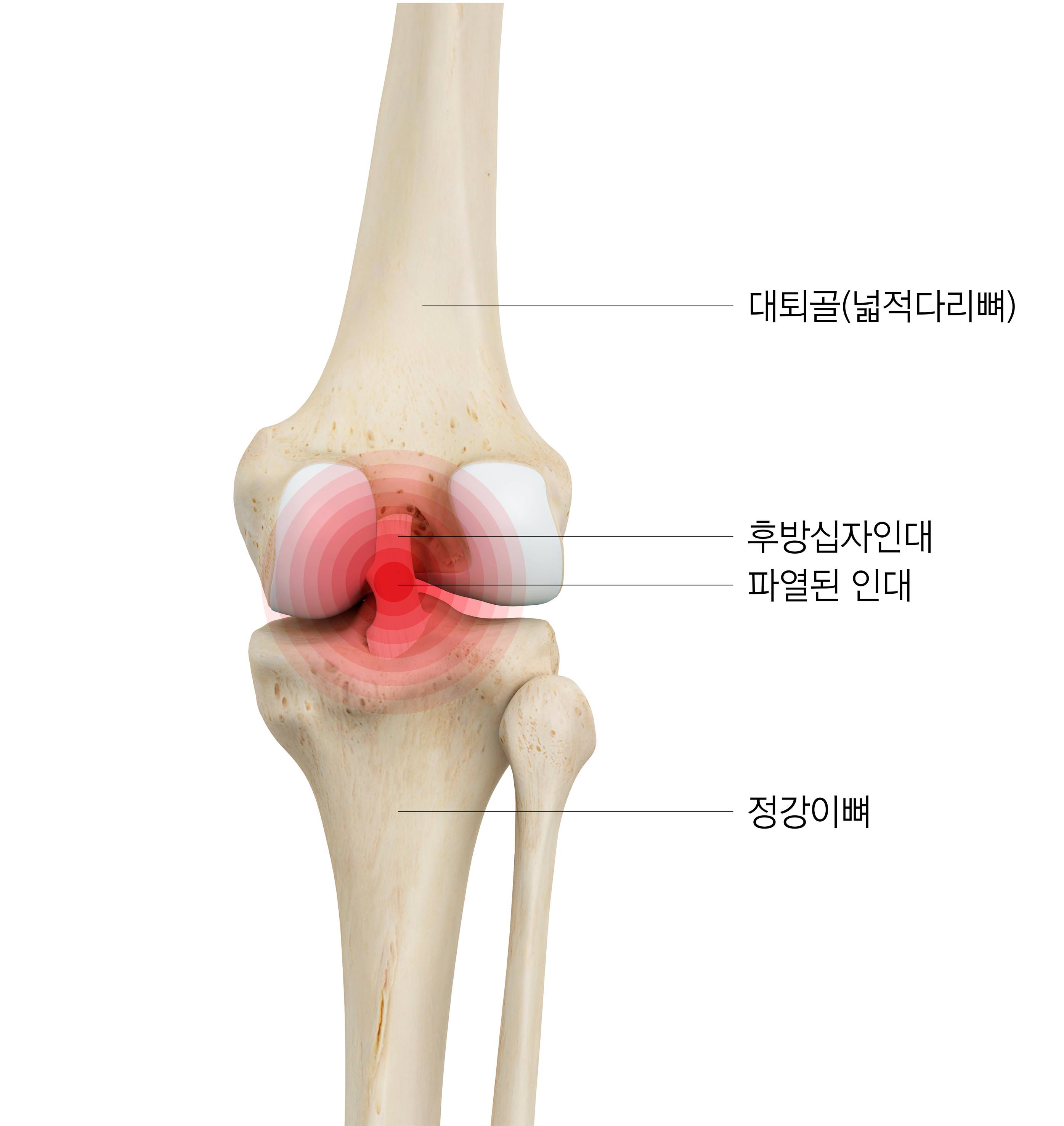 가벼운 무릎 통증 무시 말아야…원인 찾아 치료·관리를 - 중앙일보헬스미디어